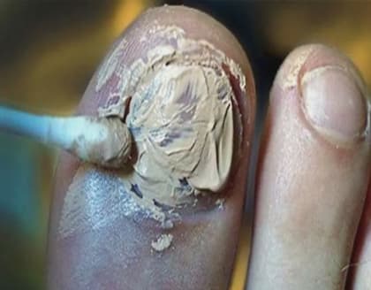 Do This Before Bed And The Fungus Will Disappear In The Bud!
