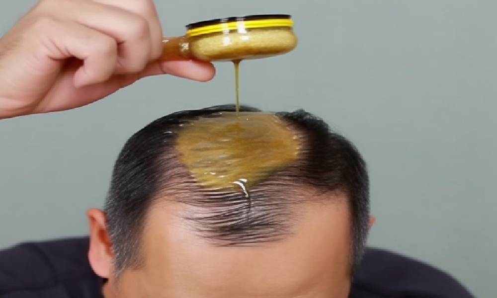 Hair Will Grow Back! No Matter How Severe The Baldness