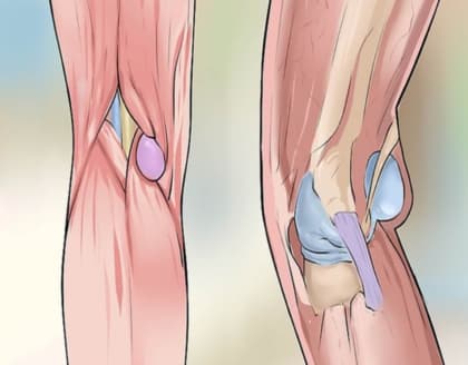 Arthritis & Knee Pain Will Disappear Forever If You Do This!